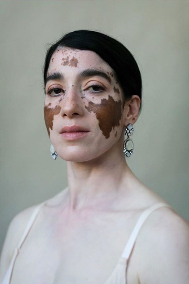 33 Jolies Femmes Atteintes De Vitiligo Capturées Par Une Photographe